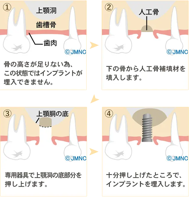 ソケットリフト