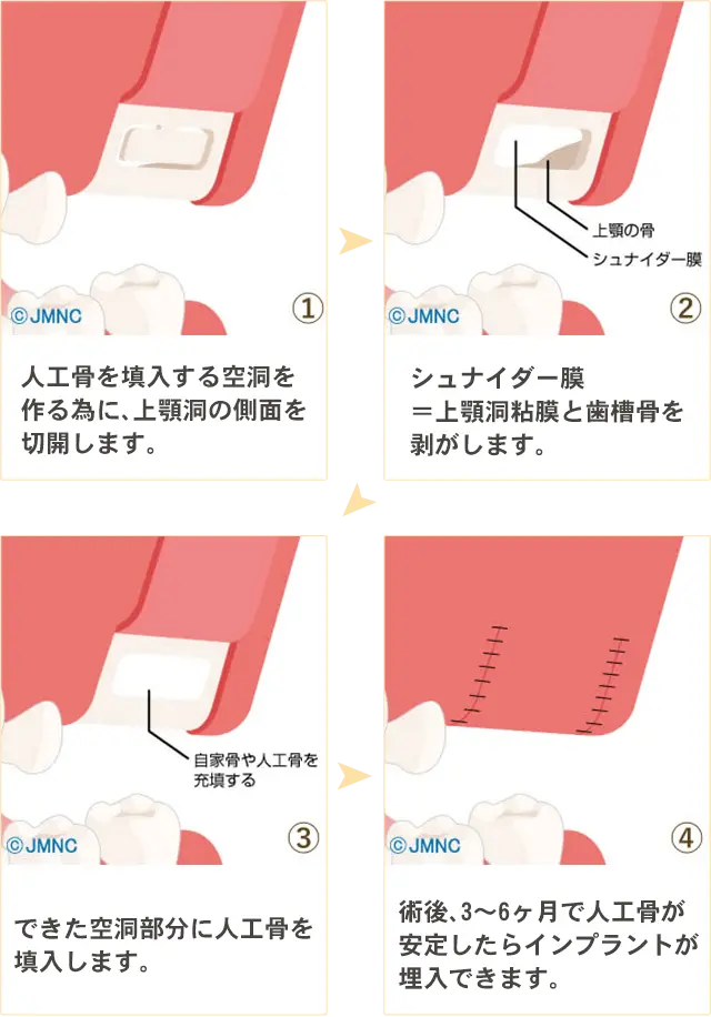 サイナスリフト