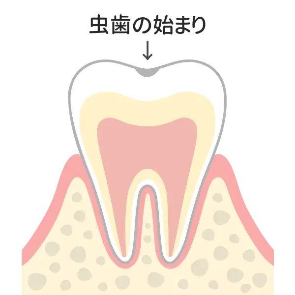 Ｃ０：脱灰