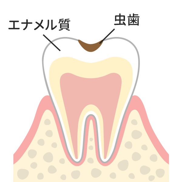 歯の表層（エナメル質）の虫歯