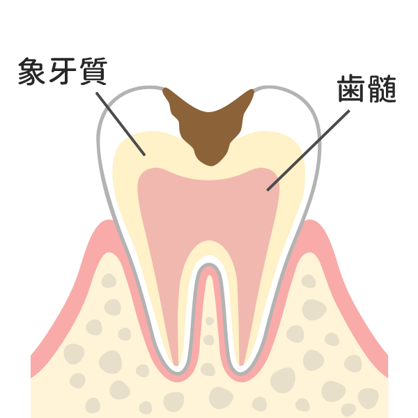 歯の中（象牙質）の虫歯