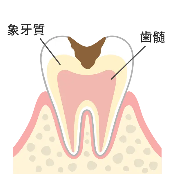 歯の中（象牙質）の虫歯