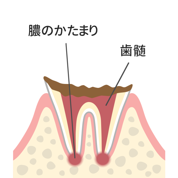 歯の根まで達した虫歯