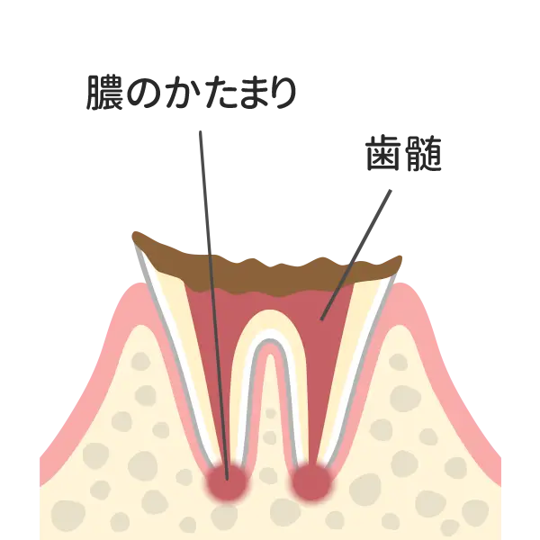 歯の根まで達した虫歯