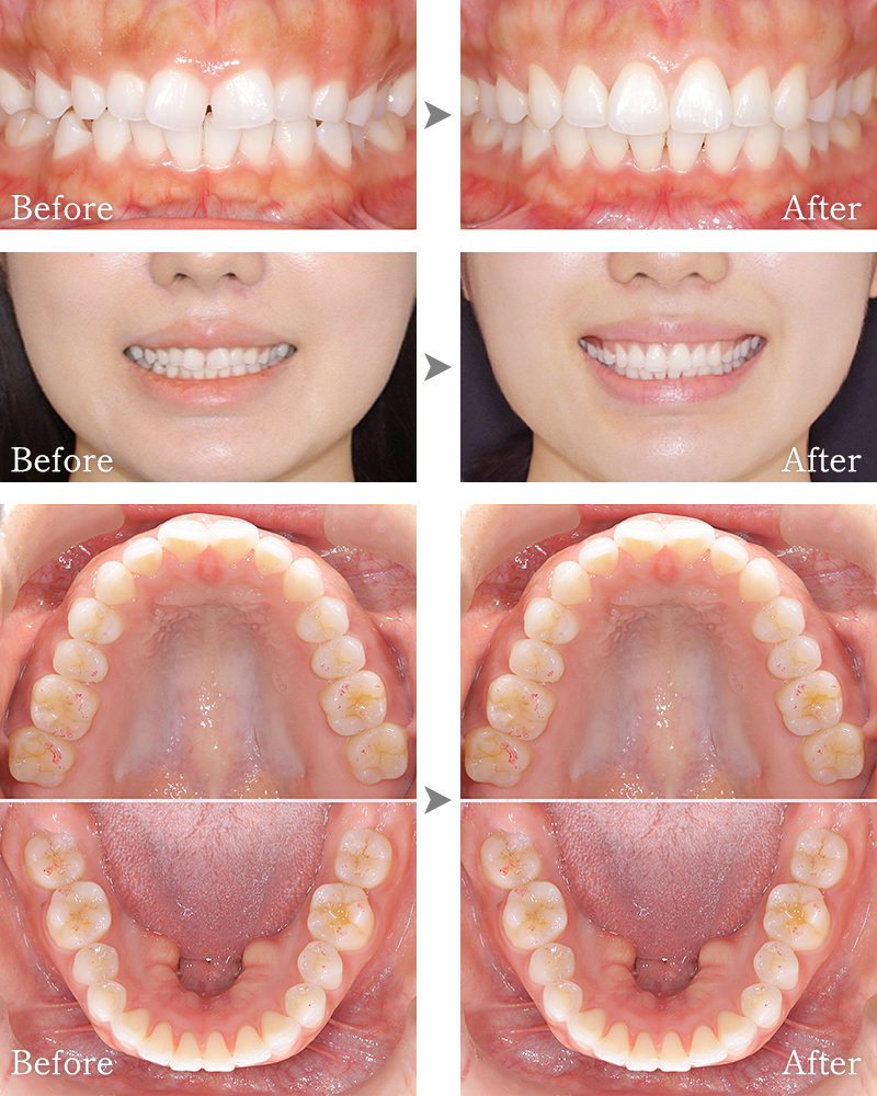 インプラント症例1