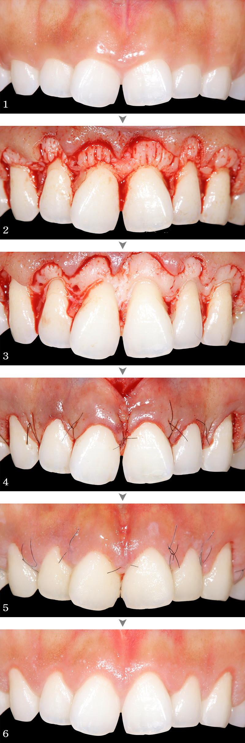 インプラント症例1-2