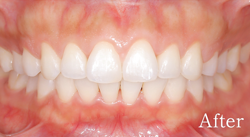 インプラント症例1