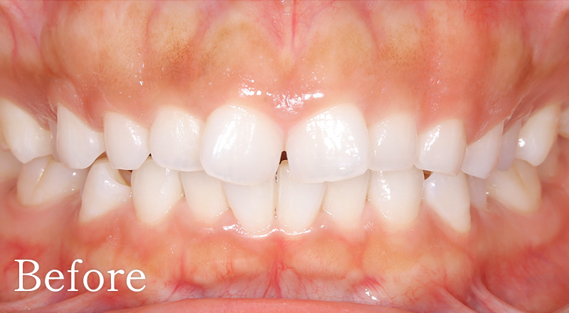 インプラント症例1