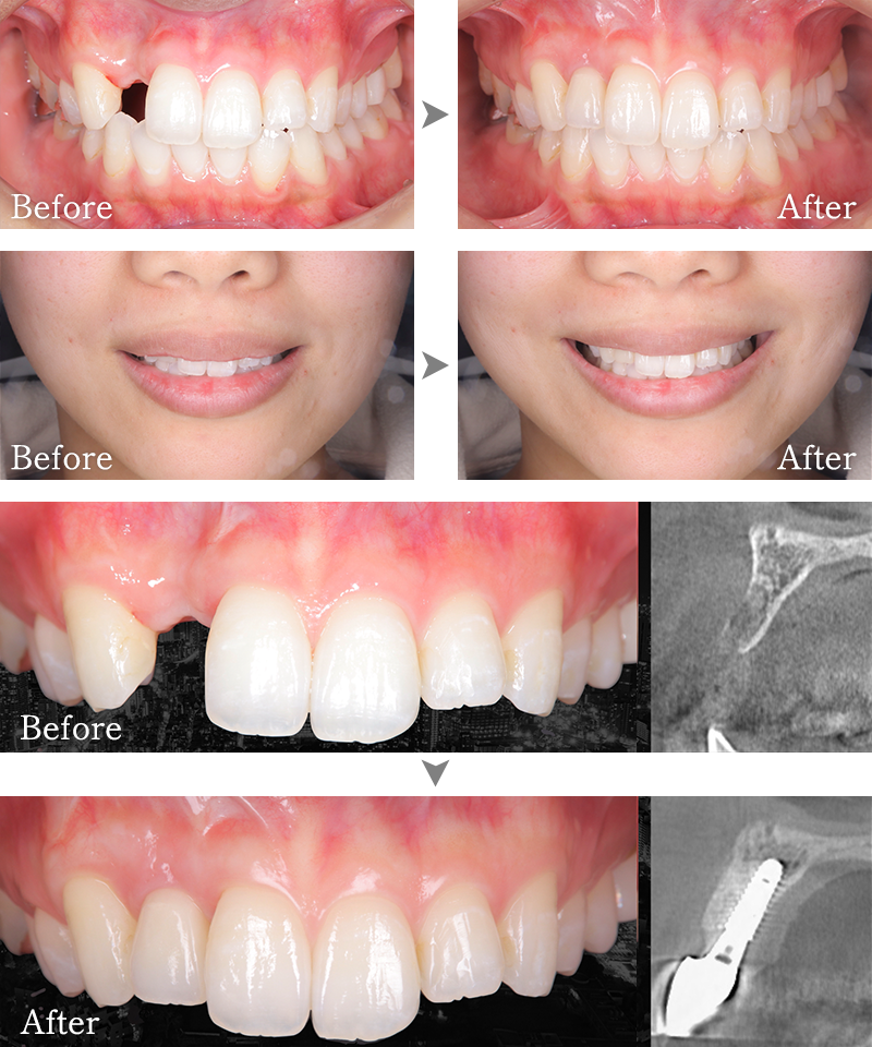 インプラント症例2
