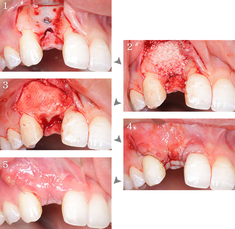 インプラント症例2-2