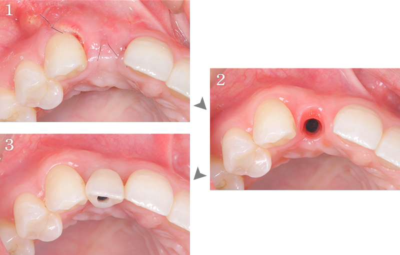 インプラント症例2-3