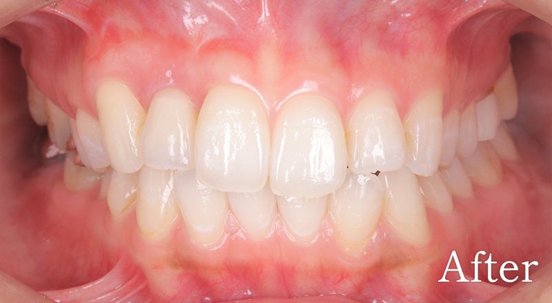 インプラント症例2