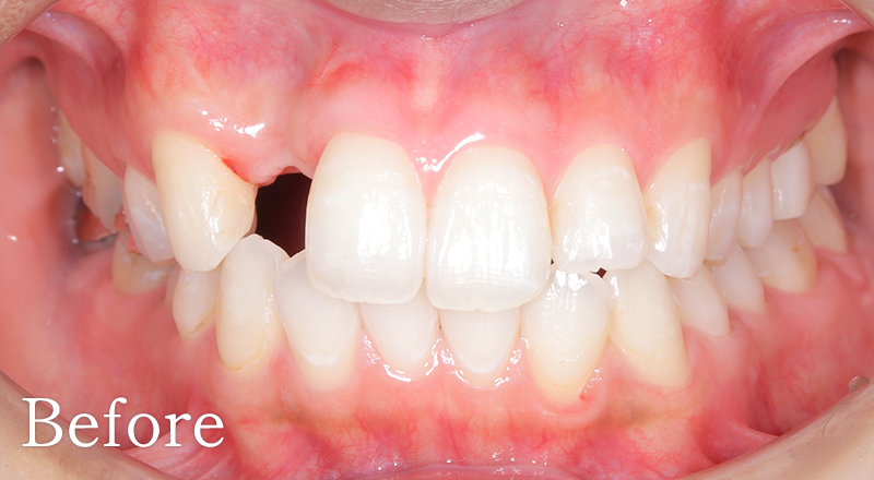 インプラント症例2