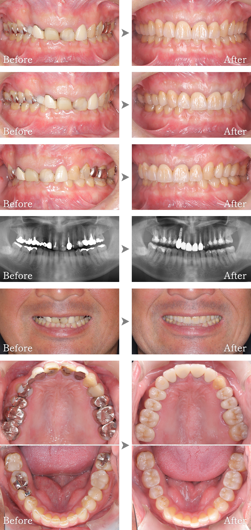 インプラント症例3