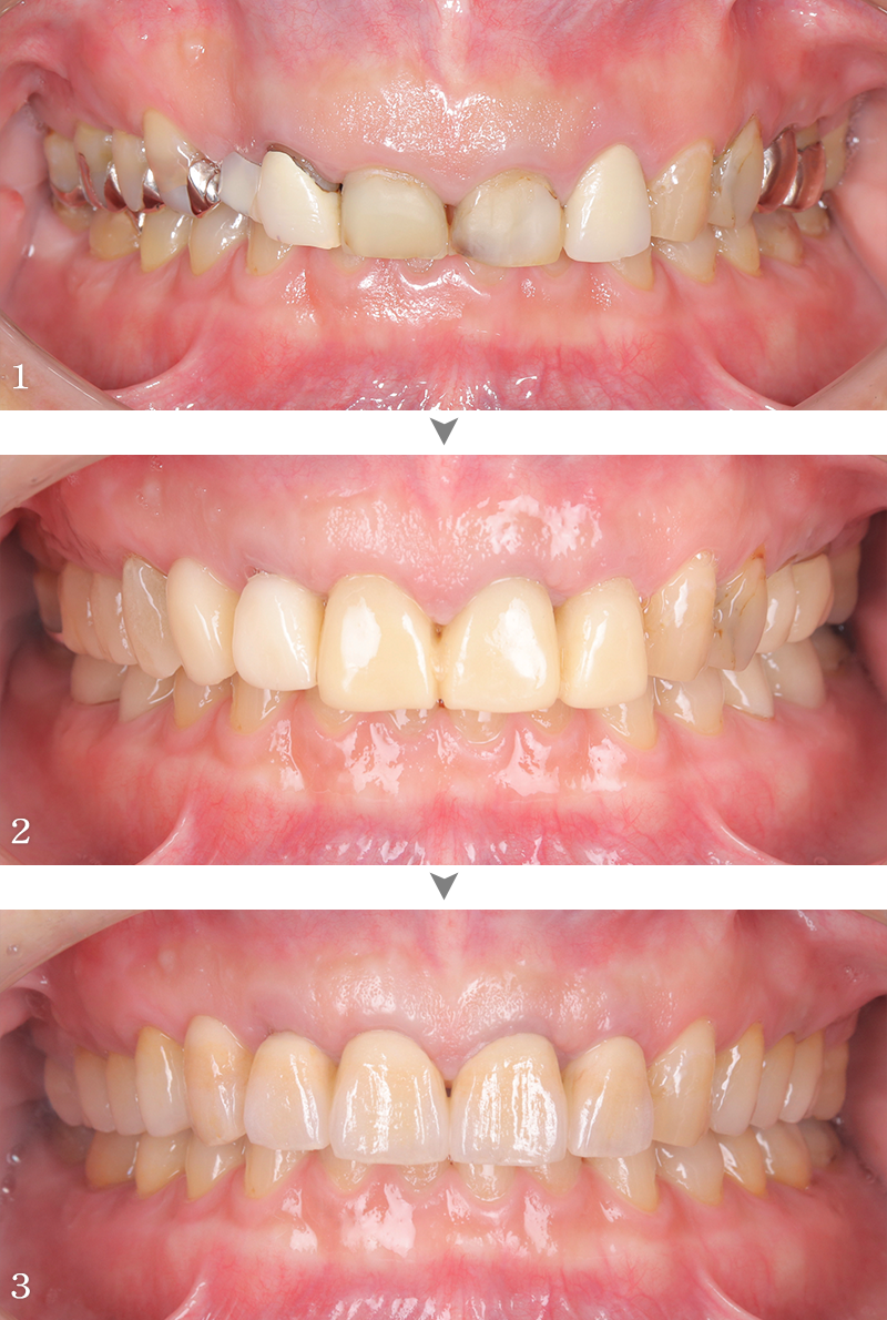インプラント症例3-2