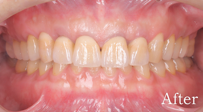 インプラント症例3