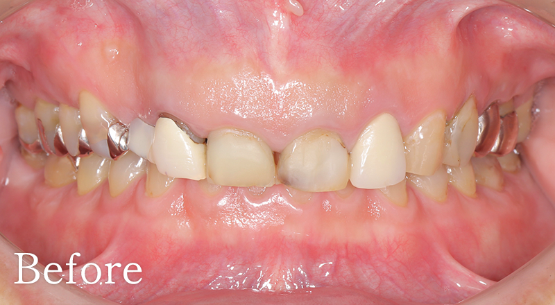 インプラント症例3