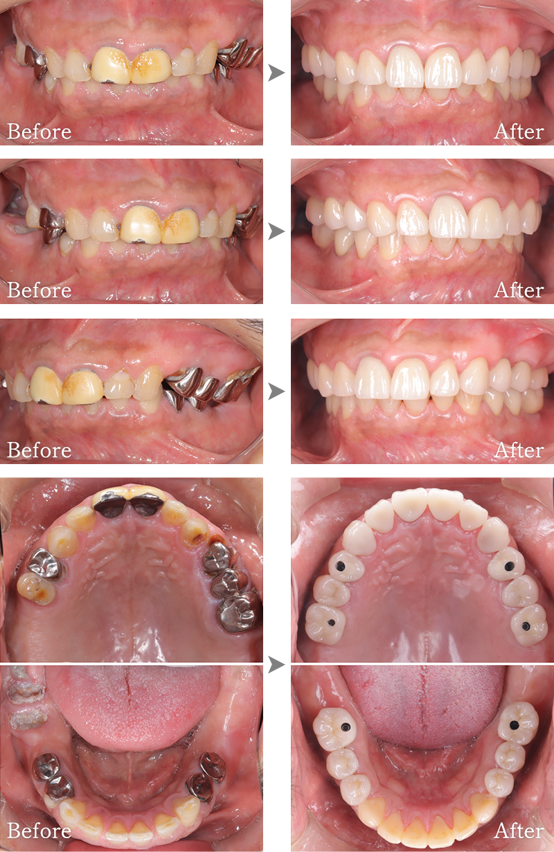 インプラント症例4