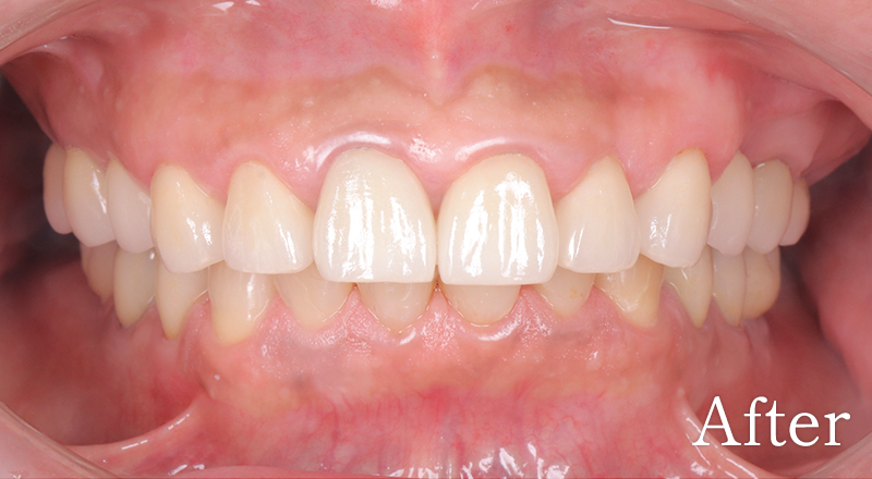 インプラント症例4