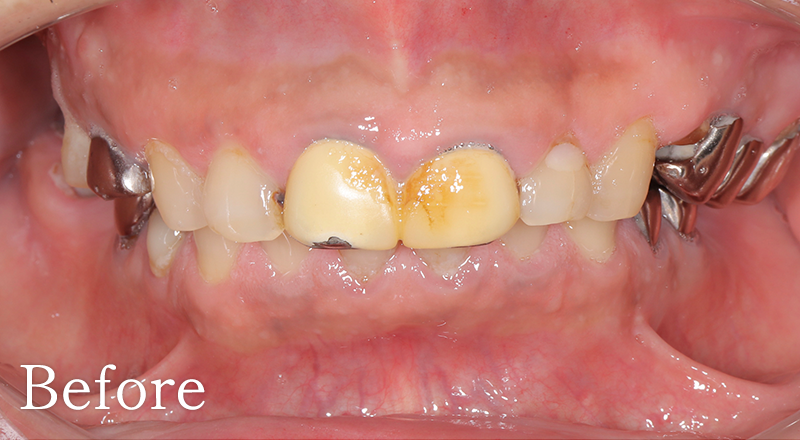 インプラント症例4