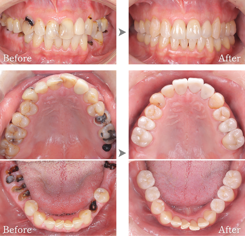 インプラント症例5