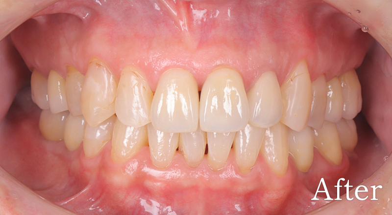 インプラント症例5