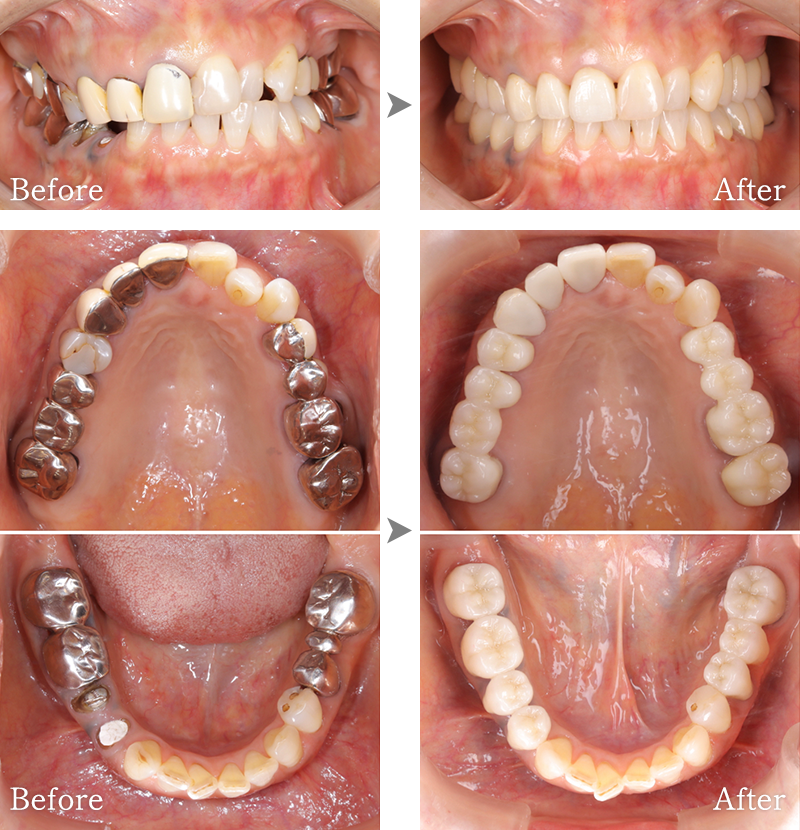 インプラント症例6