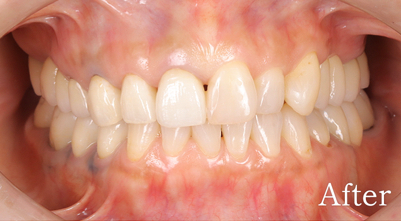 インプラント症例6