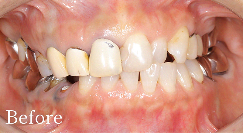 インプラント症例6