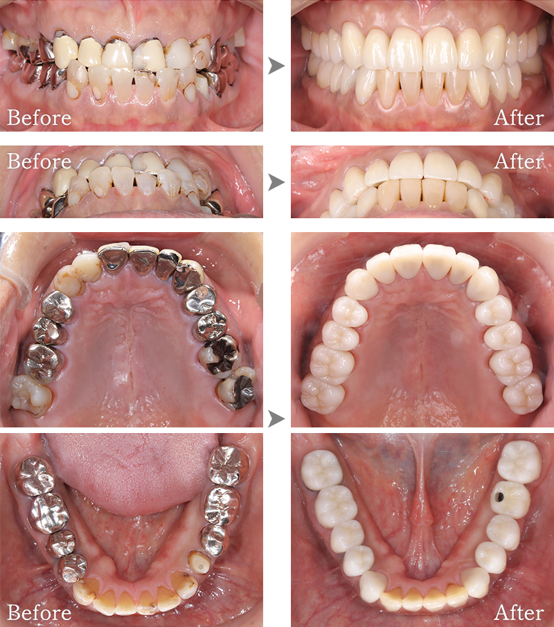 インプラント症例7