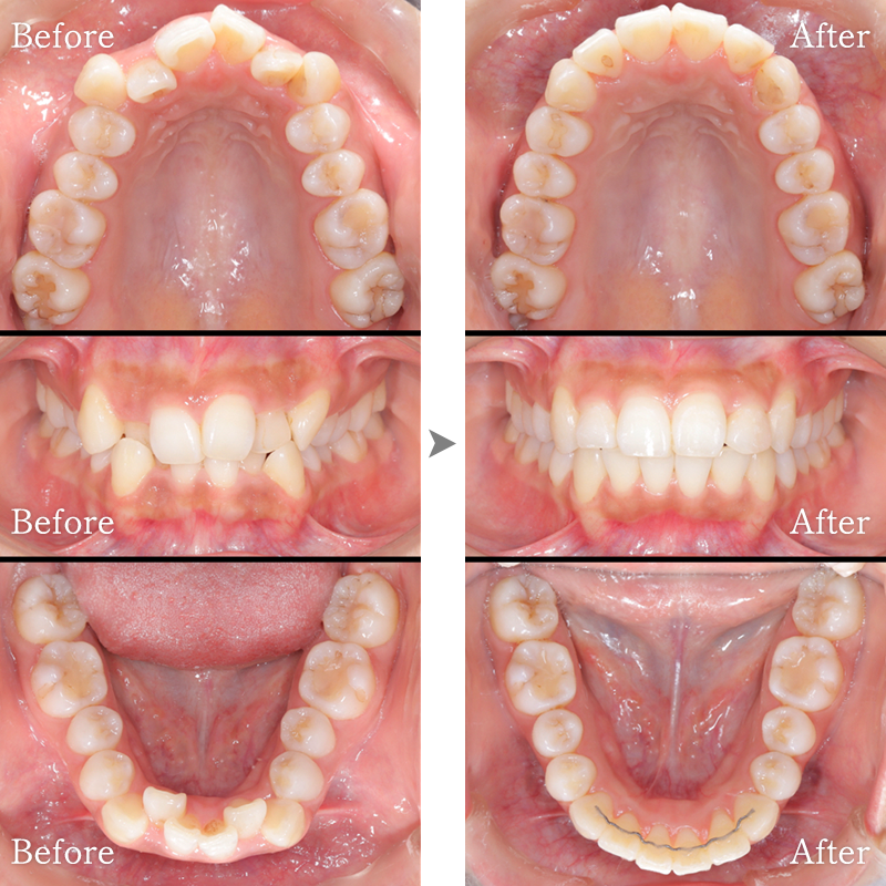 矯正歯科症例1