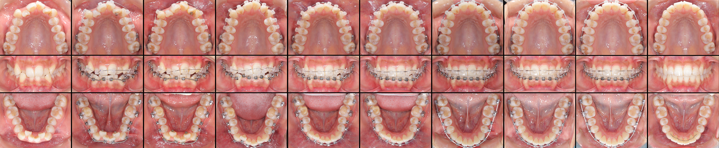 矯正歯科症例1-2