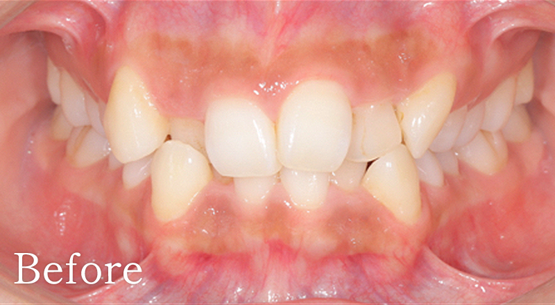 矯正歯科症例1