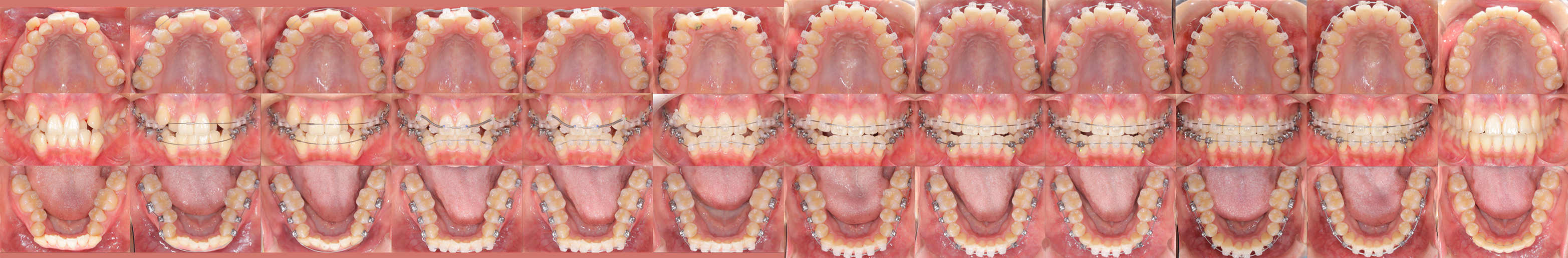 矯正歯科症例1-2