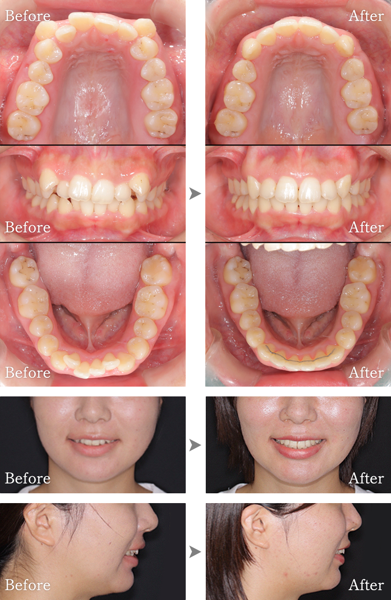 矯正歯科症例3