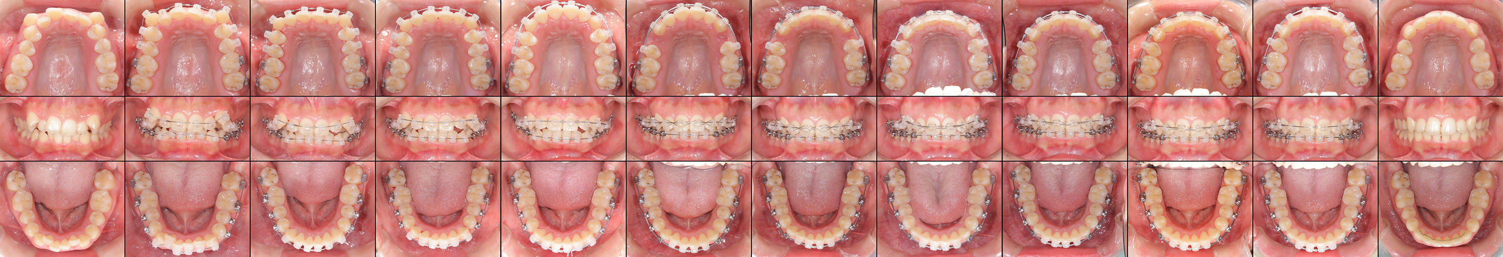 矯正歯科症例1-2