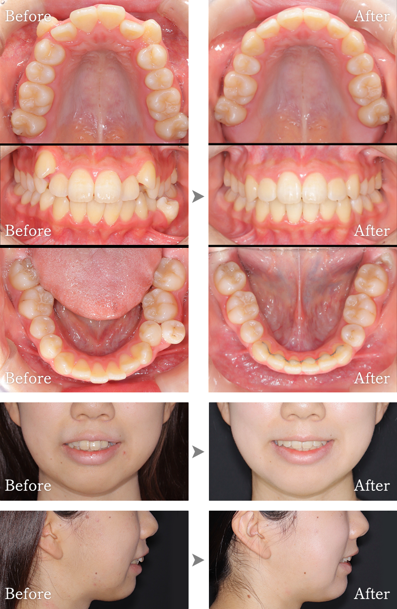 矯正歯科症例4