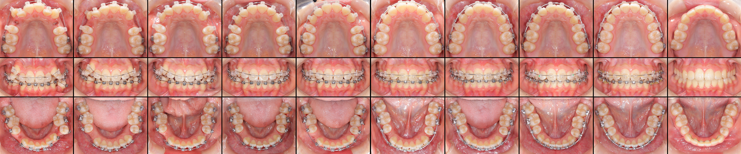 矯正歯科症例1-2