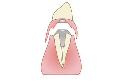 磁性アタッチメント（自費）
