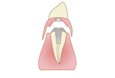 磁性アタッチメント（自費）