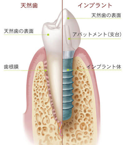 インプラント