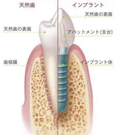 インプラント