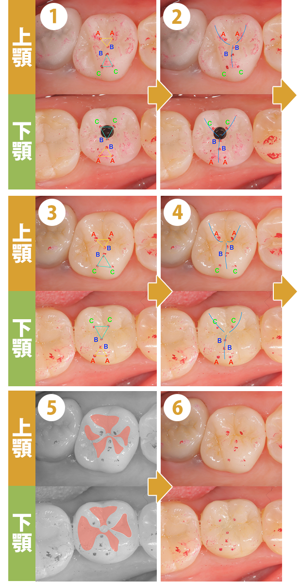 インプラント治療の症例