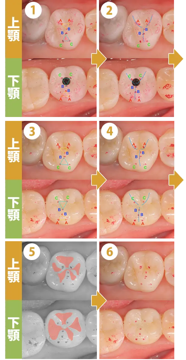インプラント治療の症例