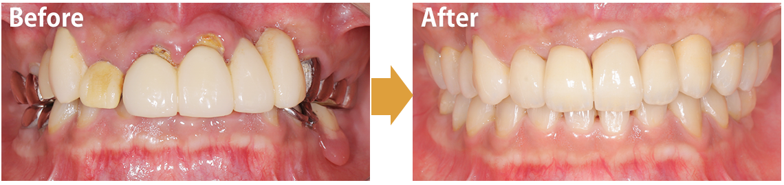 インプラント治療の症例