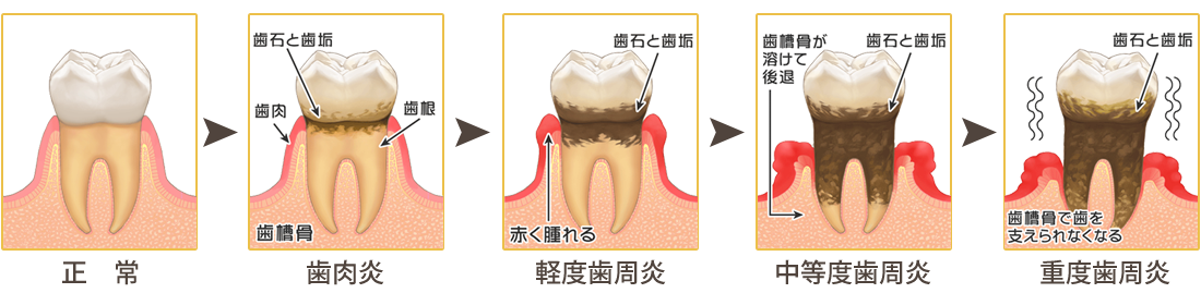 和泉市　歯周病の進行