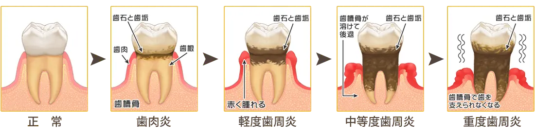 和泉市　歯周病の進行