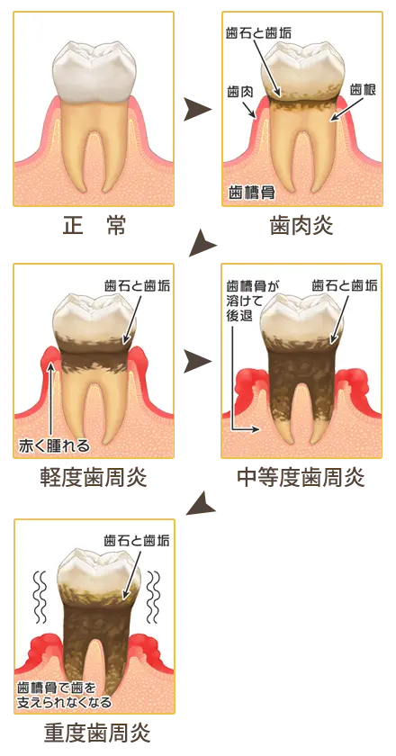 和泉市　歯周病の進行