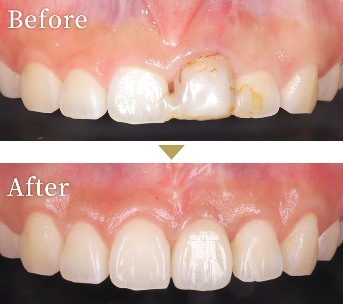 インプラント症例１
