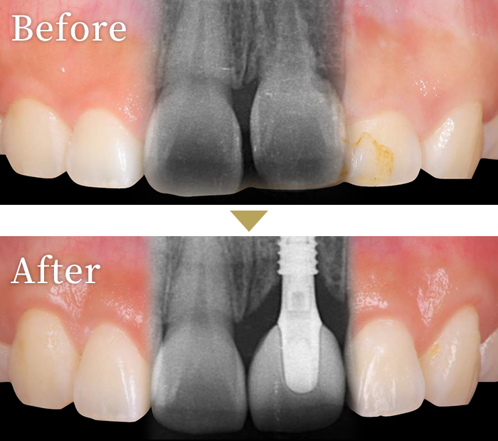 インプラント症例１